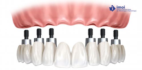 protesis fija imoi