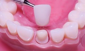 corona-porcellana-imoi