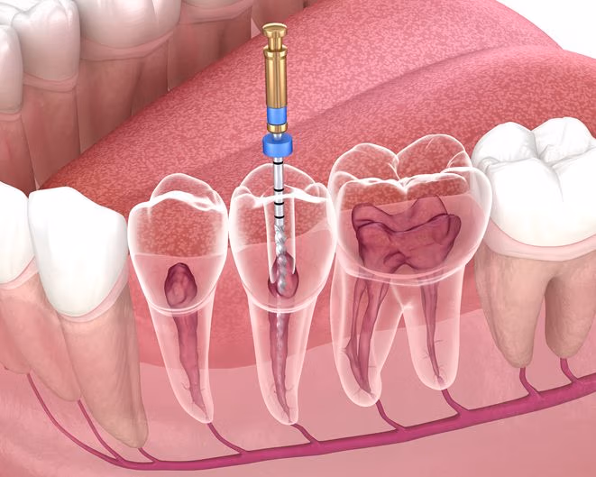 segeatment Process. Medically Accurate Tooth 3d Illustration.