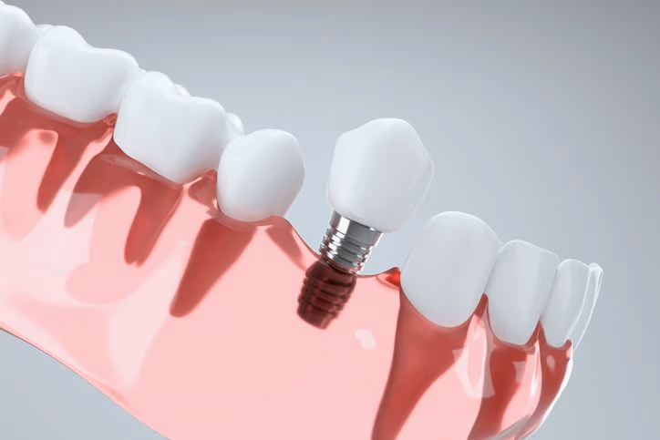 implantes dentales en barcelona