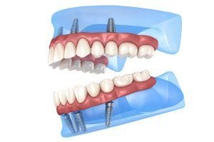 Implantes Carga Inmediata Manos Expertas