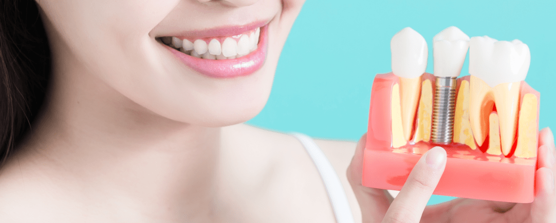 Partes Del Implante Dental