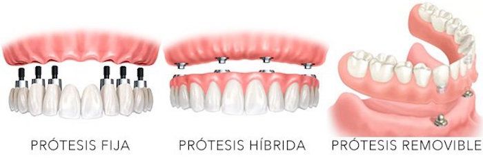 prótesis dentales